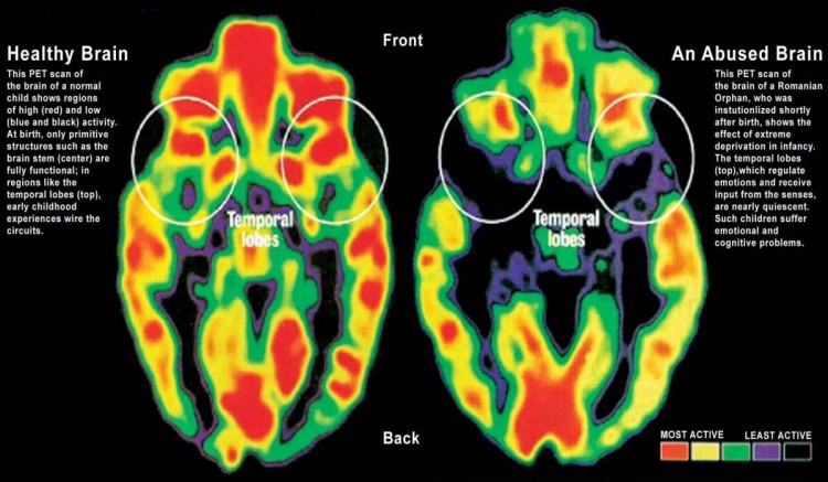 How Does Emotional Abuse Affect Brain Development